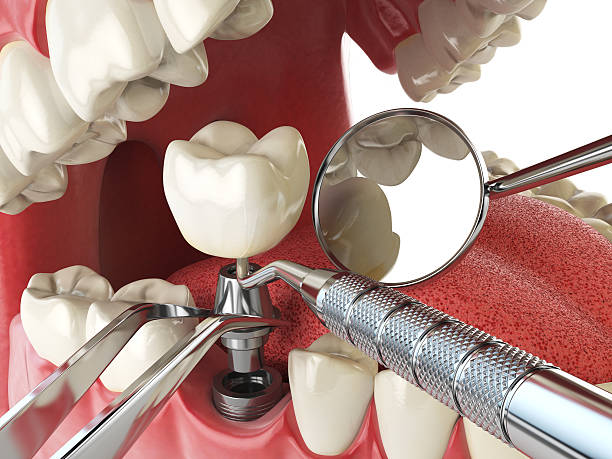 Best Emergency Root Canal Treatment in Upper Lake, CA